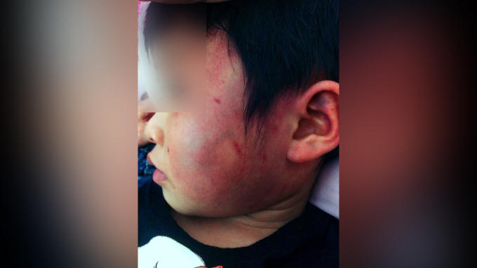 Cháu L.T.D bị đánh thâm tím mặt.