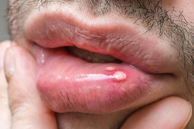 13 dấu hiệu ung thư nam giới kh&ocirc;ng được bỏ qua