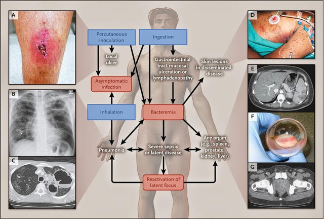 Các biểu hiện lâm sàng sau khi nhiễm vi khuẩn B. pseudomallei (nguồn: Bệnh viện Bệnh Nhiệt đới Trung ương)