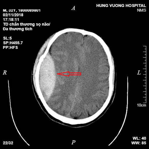 Kết quả chụp CT đa dãy sọ não trước phẫu thuật.