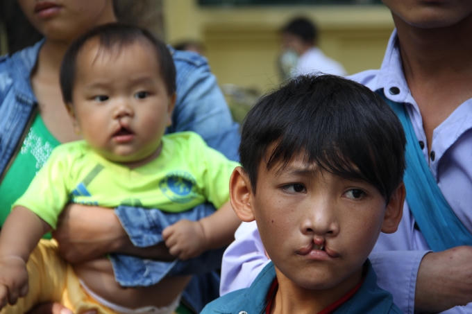 Dị tật hở môi, hàm ếch khiến trẻ gặp nhiều khó khăn trong cuộc sống hàng ngày.