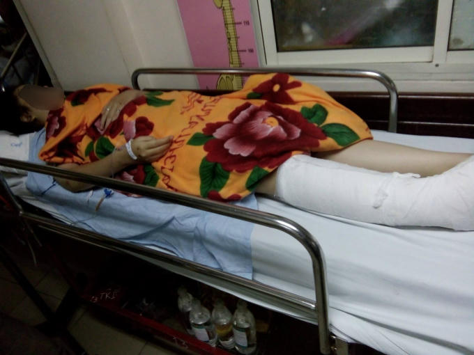 Chân phải cô gái đã được các bác sĩ bó bột.