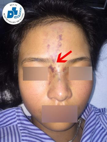 Hình ảnh bệnh nhân bị biến chứng tắc mạch, mất thị lực sau tiêm filler tại thẩm mỹ viện đến khám và điều trị tại Bệnh viện Da liễu Trung ương ngày 22/10/2019. Ảnh: BV Da liễu TW