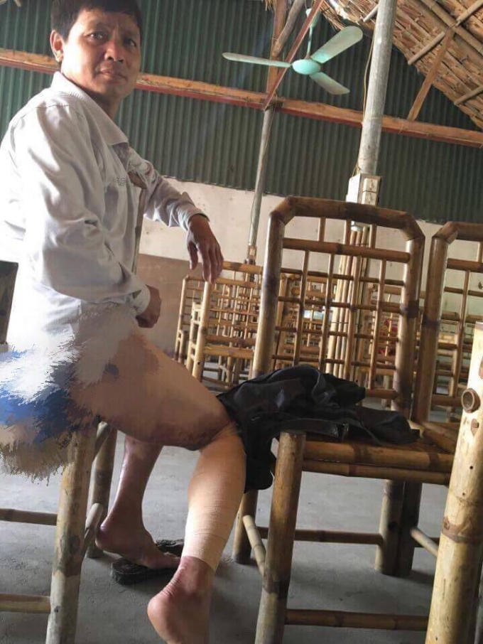 Vết thương của ông Chỉnh do bị tưới xăng đốt.