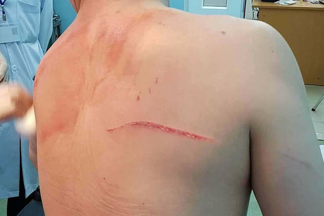 Thương tích trên người bác sĩ Chiêm Quốc Thái do vợ cũ thuê giang hồ truy sát.