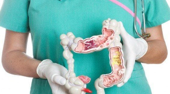 Viêm đại tràng có nhiều ổ viêm loét.