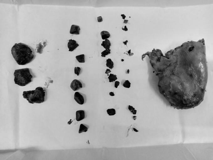 Một phần các viên sỏi và túi mật sau khi được lấy ra ngoài.