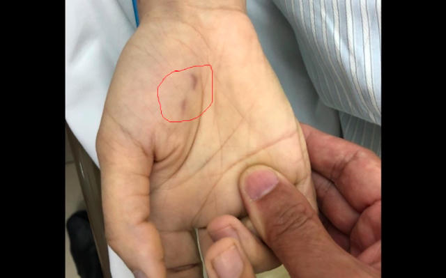 Vết thương chó cắn bàn tay phải của chị C. Ảnh giadinh.net