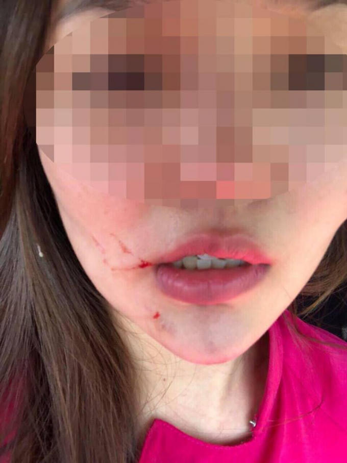 Nữ tiếp viên Đ.K.H. bị chấn thương phần mềm, tinh thần hoảng loạn