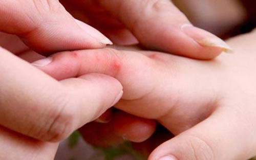 Trong tuần ghi nhận 97 ca mắc tay chân miệng. Ảnh: minh họa