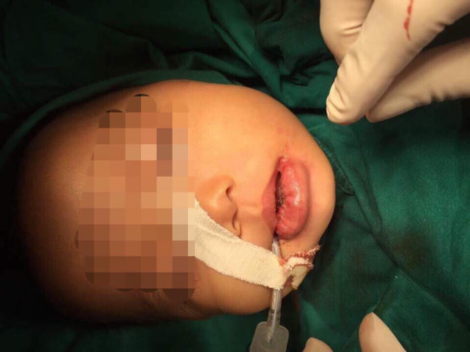 HÌnh ảnh sau khi phẫu thuật