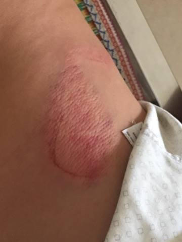 Theo chẩn đoán của bác sỹ, anh Quốc Việt bị gãy 1 xương sườn (ảnh ĐT)