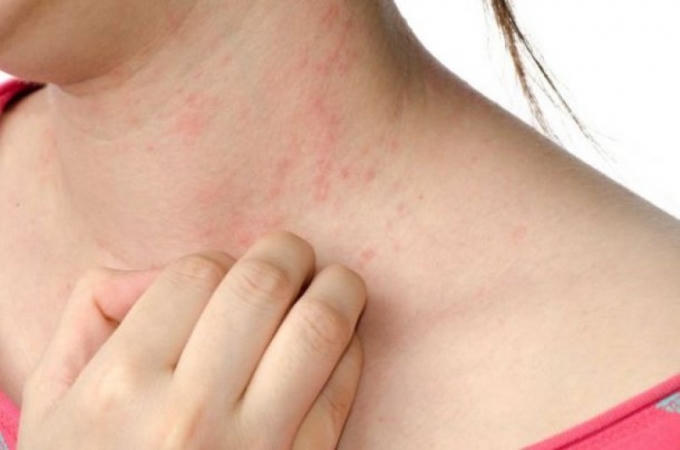 Những bệnh về da thường xuất hiện khi cơ thể tiếp xúc với nước mưa và những vật dụng để tránh mưa. Ảnh: minh họa