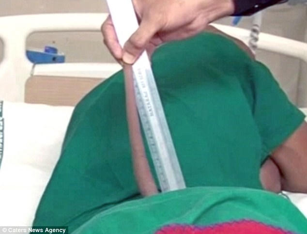 Đuôi dài 17,78 cm của nam thanh niên 18 tuổi người Ấn Độ