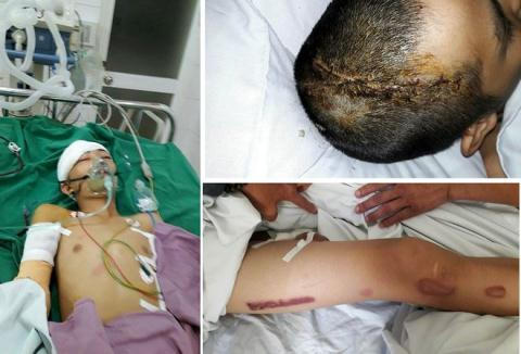 Tùng khai bị ông Phương chém 2 nhát vào đầu, gãy tay và bị con trai ông Phương dùng dùi cui dí nhiều nhát vào người khiến bị bỏng nặng. Ảnh: PLVN