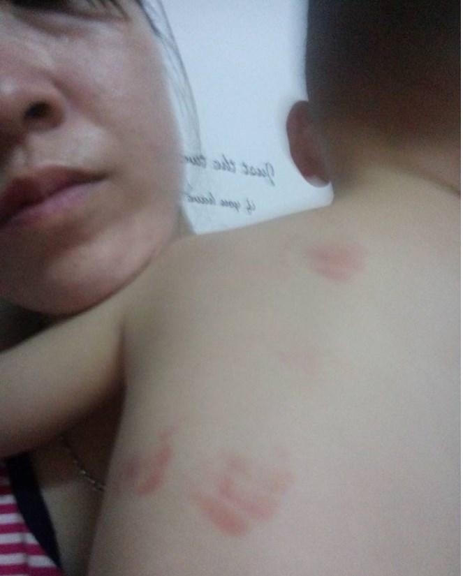 Hình ảnh những vết bầm tím trên lưng bé trai 20 tháng tuổi. (Ảnh: Infonet)