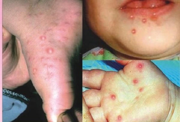 Tay - chân - miệng là bệnh nhiễm trùng do virus. Ảnh: minh họa