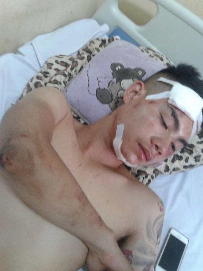 Cơ thể anh Dương Văn T., xuất hiện hàng chục vết thương...