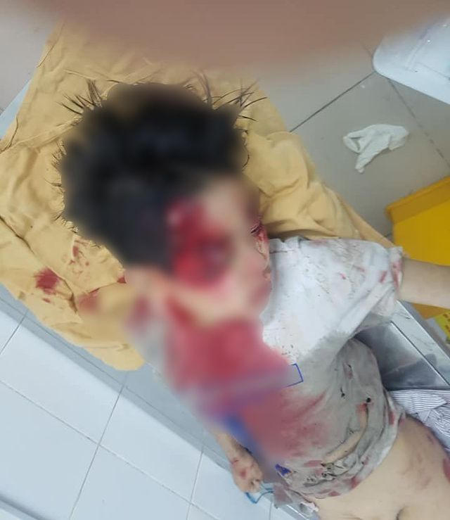 Bé trai bị thương nặng.