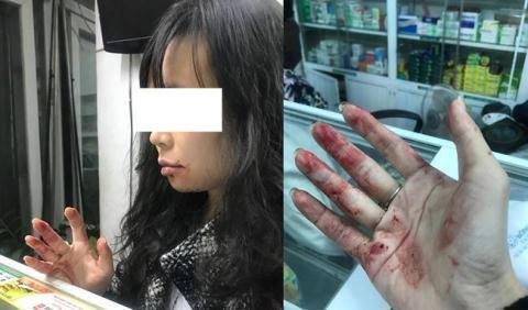 Chị Linh bị tài xế Uber đánh đến "bầm mặt".