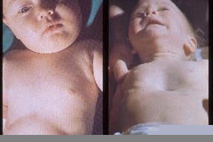 Trẻ khó thở: rút lõm lồng ngực.