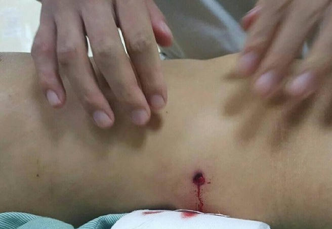 H&igrave;nh ảnh nạn nh&acirc;n bị bắn tr&uacute;ng bụng, nguy hiểm đến t&iacute;nh mạng.