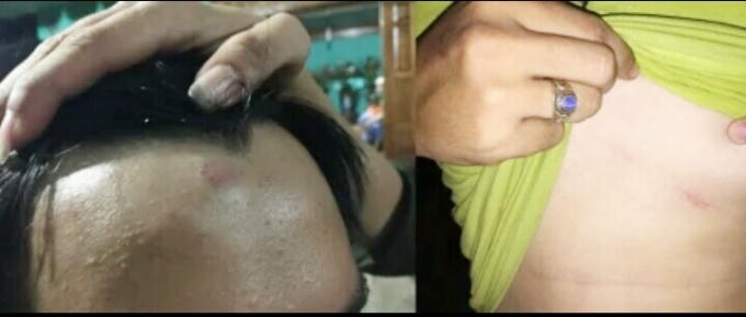 Những vết bầm tím trên người anh Việt. (ẢNh: QT).