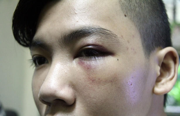 Các bác sĩ chẩn đoán Phong bị tụ máu mắt trái, rạn xương gò má trái sau trận "mưa đòn" vì bị nghi trộm chó . Ảnh: Phi Hùng