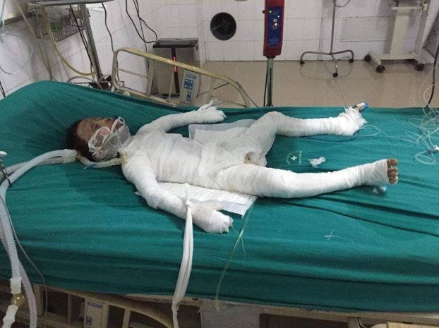 Vụ cháy khiến 3 người trong một gia đình bị thương, trong đó có một bé trai 6 tuổi. (Ảnh: báo Gia đình mới)