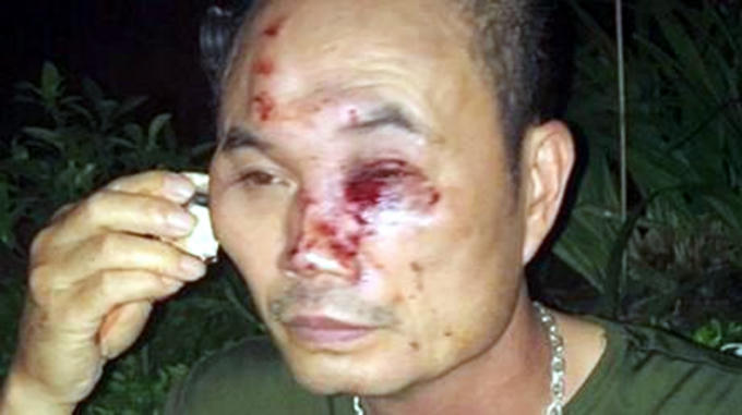 Bảo vệ chung cư bị nhóm côn đồ hành hung nhập viện.