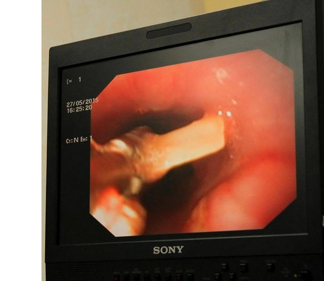 Bệnh nhân bị hóc xương gà rất nguy hiểm