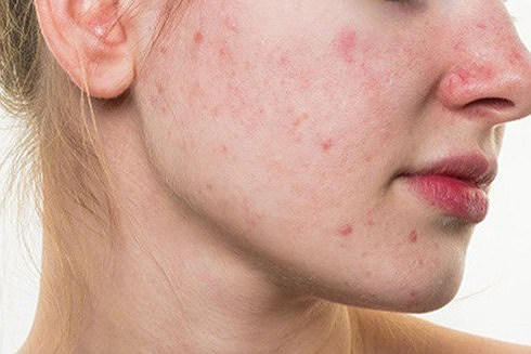 Mụn nhọt:Những vùng da bị tổn thương do mụn nhọt hoặc viêm nhiễm da lâu ngày sẽ có nguy cơ xuất hiện ung thư da hơn các vị trí da khác. Lý do là bởi quá trình tái tạo lớp biểu bì của da bị ảnh hưởng, chức năng bảo vệ cơ thể của da kém hơn.