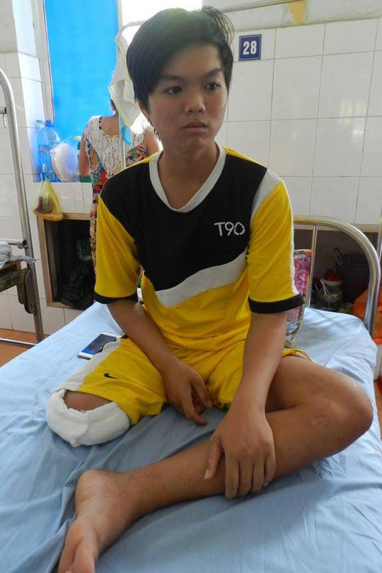 Trúc Giang đã bị cắt bỏ 1/3 chân phải.