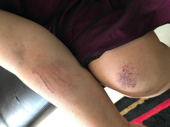 Bà Liễu bị nhóm đối tượng lạ mặt xông vào nhà đánh đập, gây thâm tim và xây xước nhiều nơi.