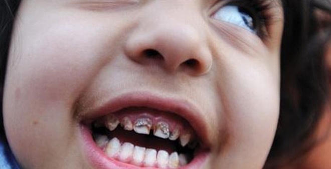 Chì có thể gây ra các thiệt hại cho hệ thống thần kinh trung ương, ngoại vi, khuyết tật, chậm lớn, suy giảm thính giác và chức năng tế bào huyết học. Ảnh: minh họa