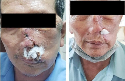 Bệnh nhân ung thư da tế bào đáy ở mũi biến chứng, gây lở loét do uống thuốc nam không rõ nguồn gốc sau khi đã được phẫu thuật
