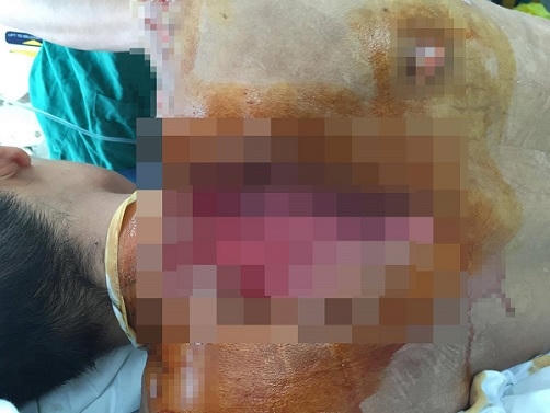 Hình ảnh vết thương của bệnh nhân Quốc tại BV Việt Đức ngày 28/6.