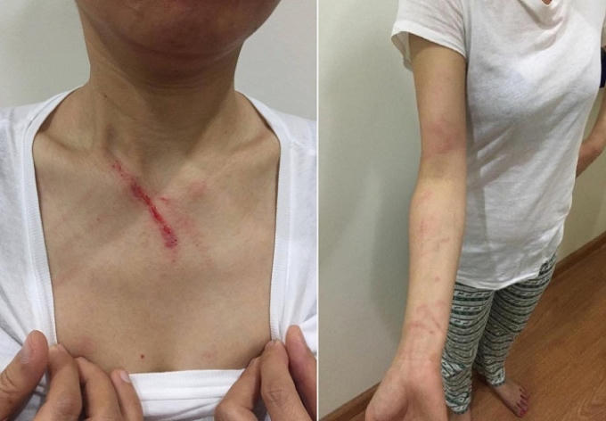 Những vết thương trên cơ thể chị Vân sau khi bị đánh vì nhắc nhở người khác không được nhổ bậy. (Ảnh: FB Khanh Van Do).