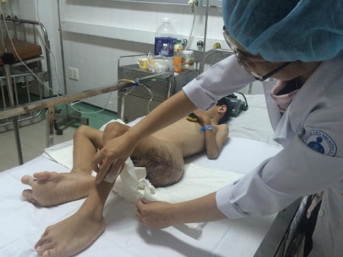 Hội chứng hiếm gặp khiến các đầu ngón chân bé cũng to nhỏ bất thường. Ảnh: Lê Phương.