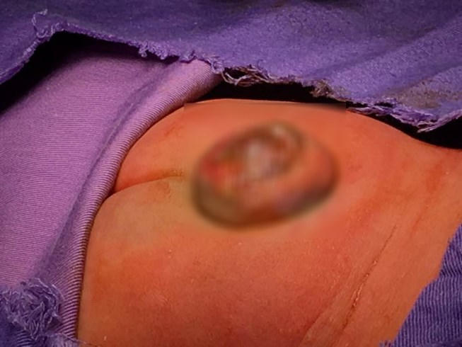 H&igrave;nh ảnh khối tho&aacute;t vị sau lưng trẻ sơ sinh 2 ng&agrave;y tuổi. Ảnh: BVCC