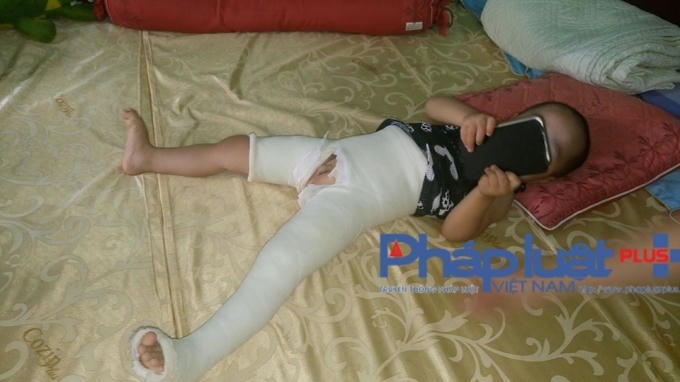 Cháu Nguyễn Hoàng Nam, vừa điều trị bó bột tại Bệnh viện Việt Đức trở về.