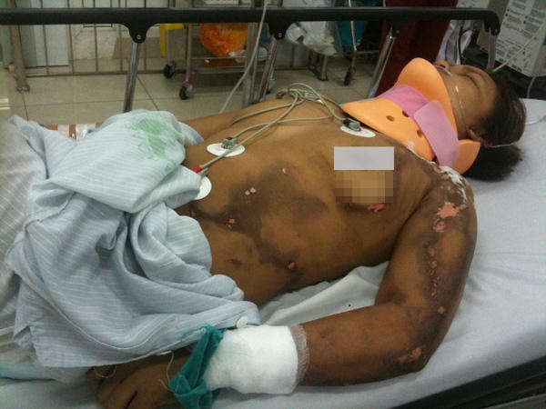Bệnh nhân bị cháy xém hết phần người. Ảnh: VietNamNet / BSCC.