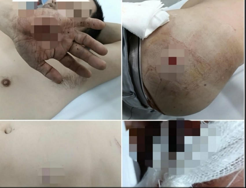 Hình ảnh chấn thương của tài xế ở Bệnh viện.