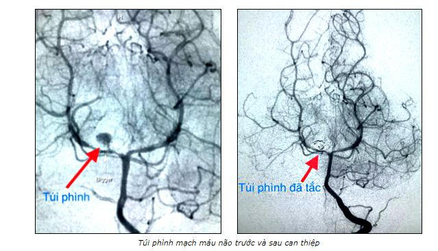 Cứu sống bệnh nhi 3 tuổi bị vỡ phình mạch não