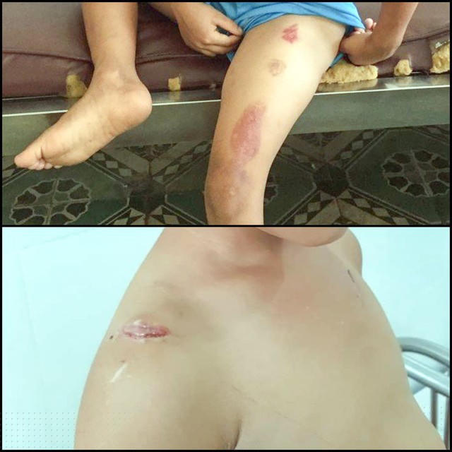 Vết thương trên đùi (ảnh trên) và vết thương trên vai (ảnh dưới) của cháu H. (Ảnh: Pháp luật TP Hồ Chí Minh)