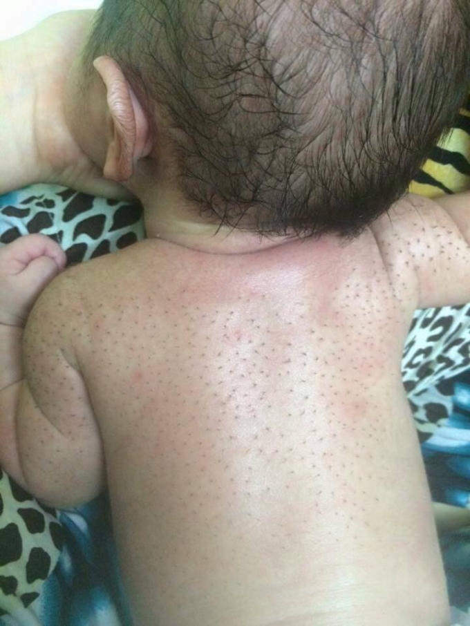 Cách trị vặn mình bằng lòng trắng trứng, nước cốt chanh và bột mỳ là phản khoa học. Ảnh Facebook.