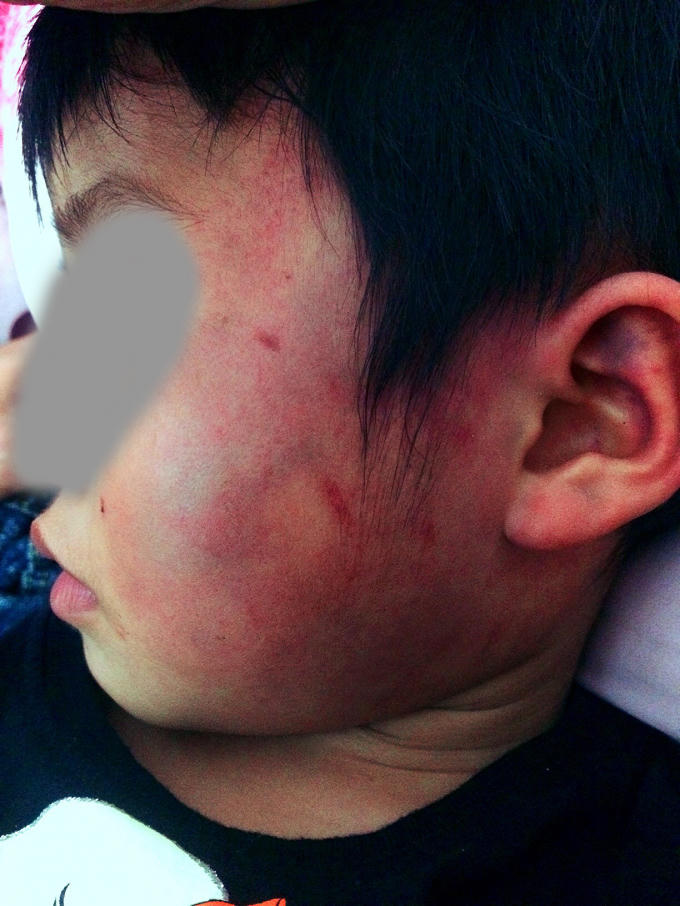 Những vết bầm tím như thế này khiến người nhà cháu L.T.D nghi ngờ bị cô giáo bạo hành chứ không phải là những đứa trẻ 4 đến 5 tuổi đánh.