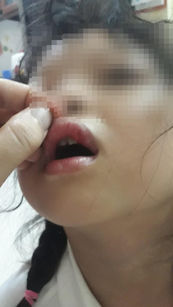 Hình ảnh môi bé H. bị dập, tụ máu nghi do bị cô giáo đánh.