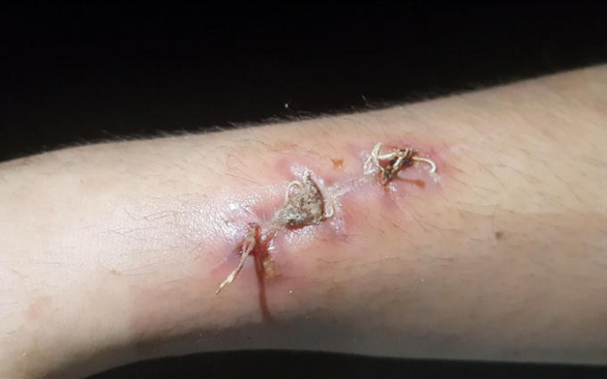 Vết thương trên tay nạn nhân phải khâu nhiều mũi. Ảnh Báo Lao Động.