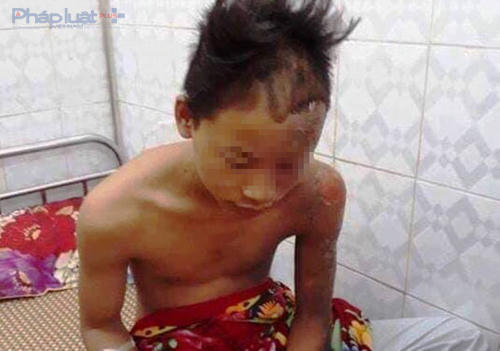 Em T.Đ.T. đã thoát chết trong gang tấc khi bị sét đánh trúng đầu. (Ảnh: A.T)